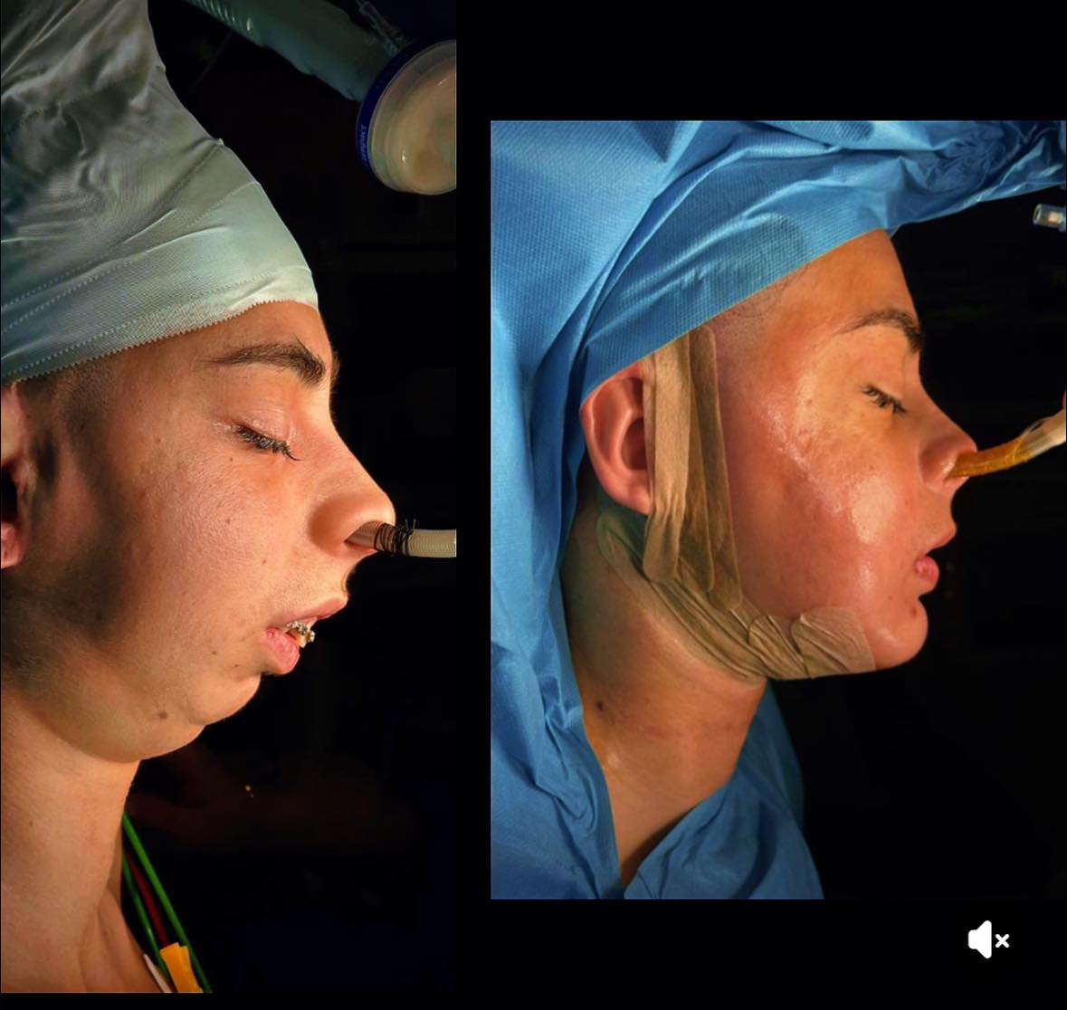 ლილიანას ოპერაცია წარმატებით დასრულდა - თურქი ექიმის დახმარებით, კიდევ ერთი ქართველი გოგონას ტრანსფორმაცია შედგა